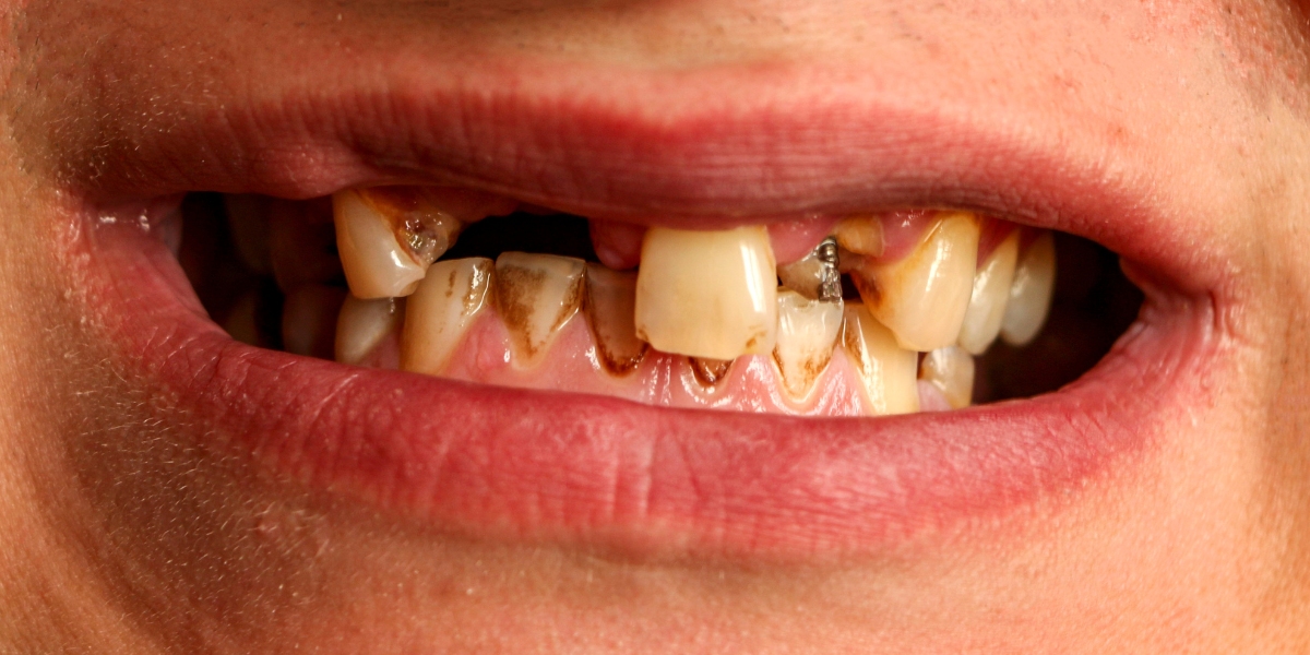 meth mouth