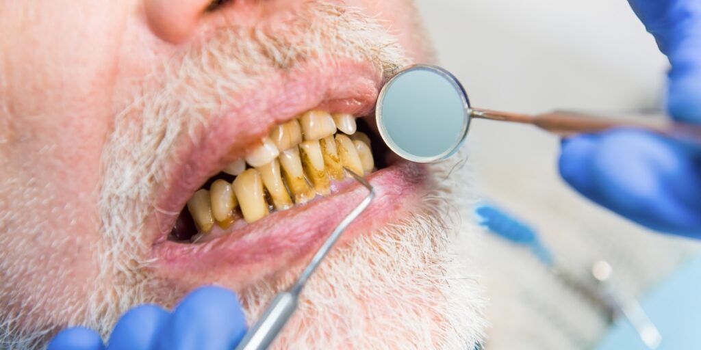 meth mouth dentist