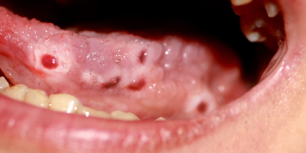 meth mouth symptoms